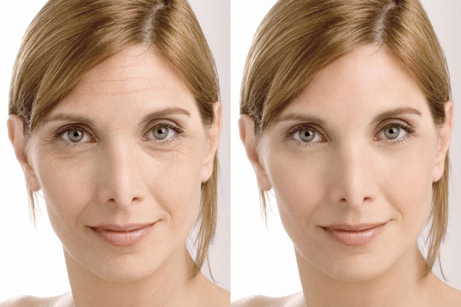 Experience of using Milana's intenskin cream before and after