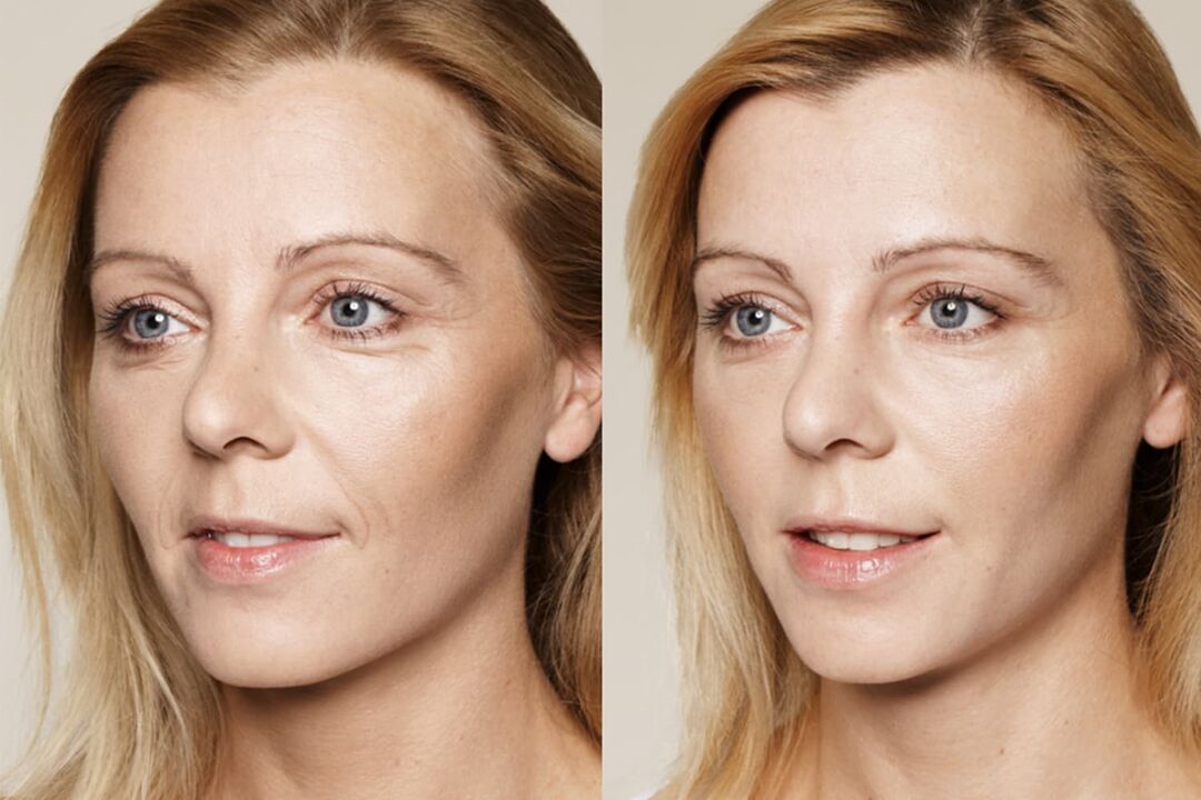 Experience of using Valeria's intenskin cream before and after